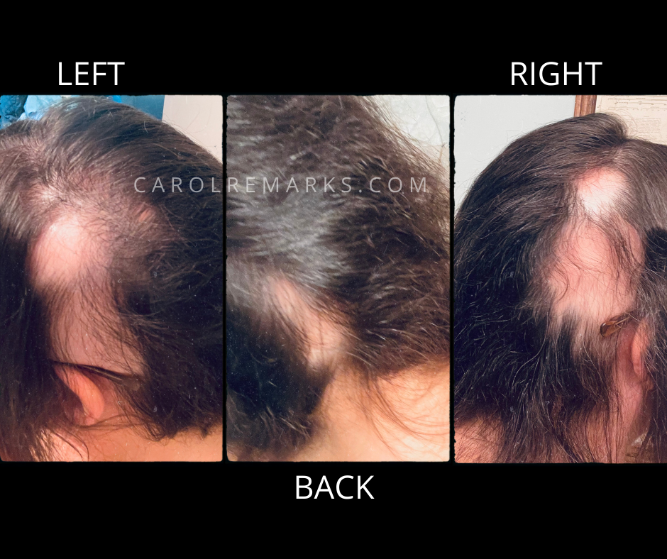 hair loss alopecia